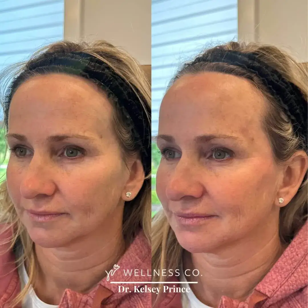 Before and after Photo | Dermal Filler | Full Face | Wellness Co. | Zeeland, MI
