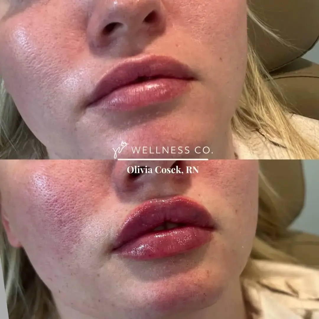 Before and after Photo | Lip Filler for fuller lips | Wellness Co. | Zeeland, MI