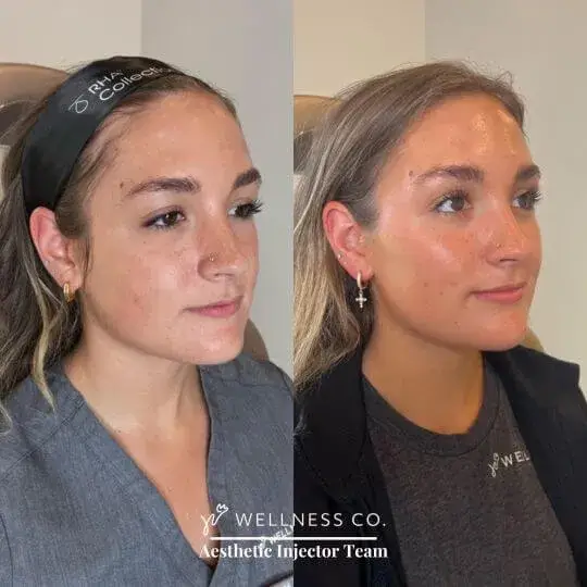 Before and after Photo | Dermal Filler | woman side pose | Wellness Co. | Zeeland, MI