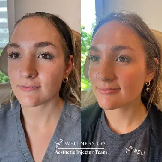 Before and after Photo | Dermal Filler | face of woman | Wellness Co. | Zeeland, MI