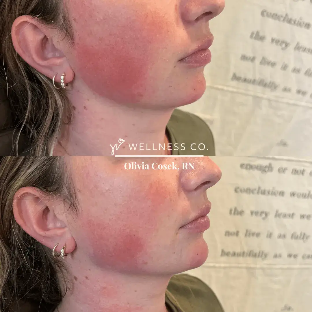 Before and after Photo | Dermal Filler for chin area | Wellness Co. | Zeeland, MI