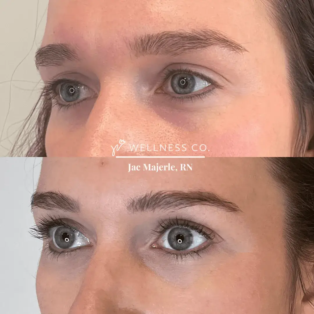 Before and after Photo | PRP treatment on face | Wellness Co. | Zeeland, MI