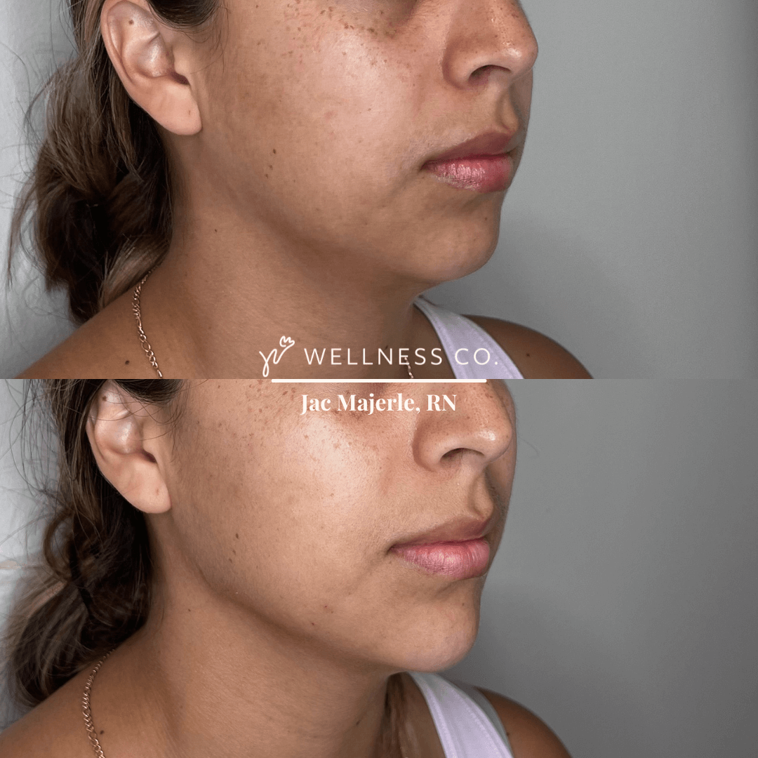 Before and After Photo | full face dermal filler | Wellness Co. | Zeeland, MI