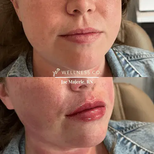 Dermal Filler for Lips