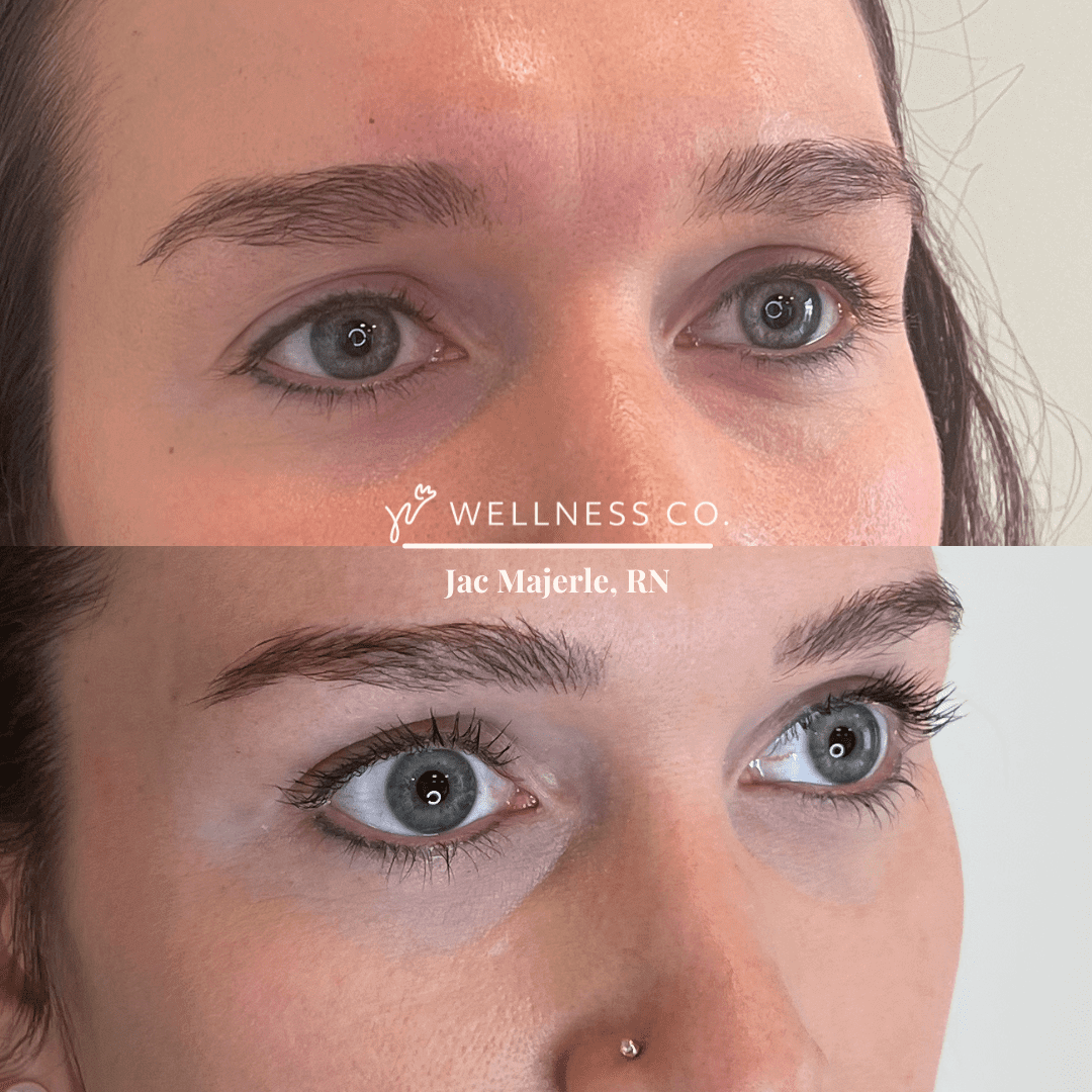 Before and after Photo | PRP Injection | Wellness Co. | Zeeland, MI