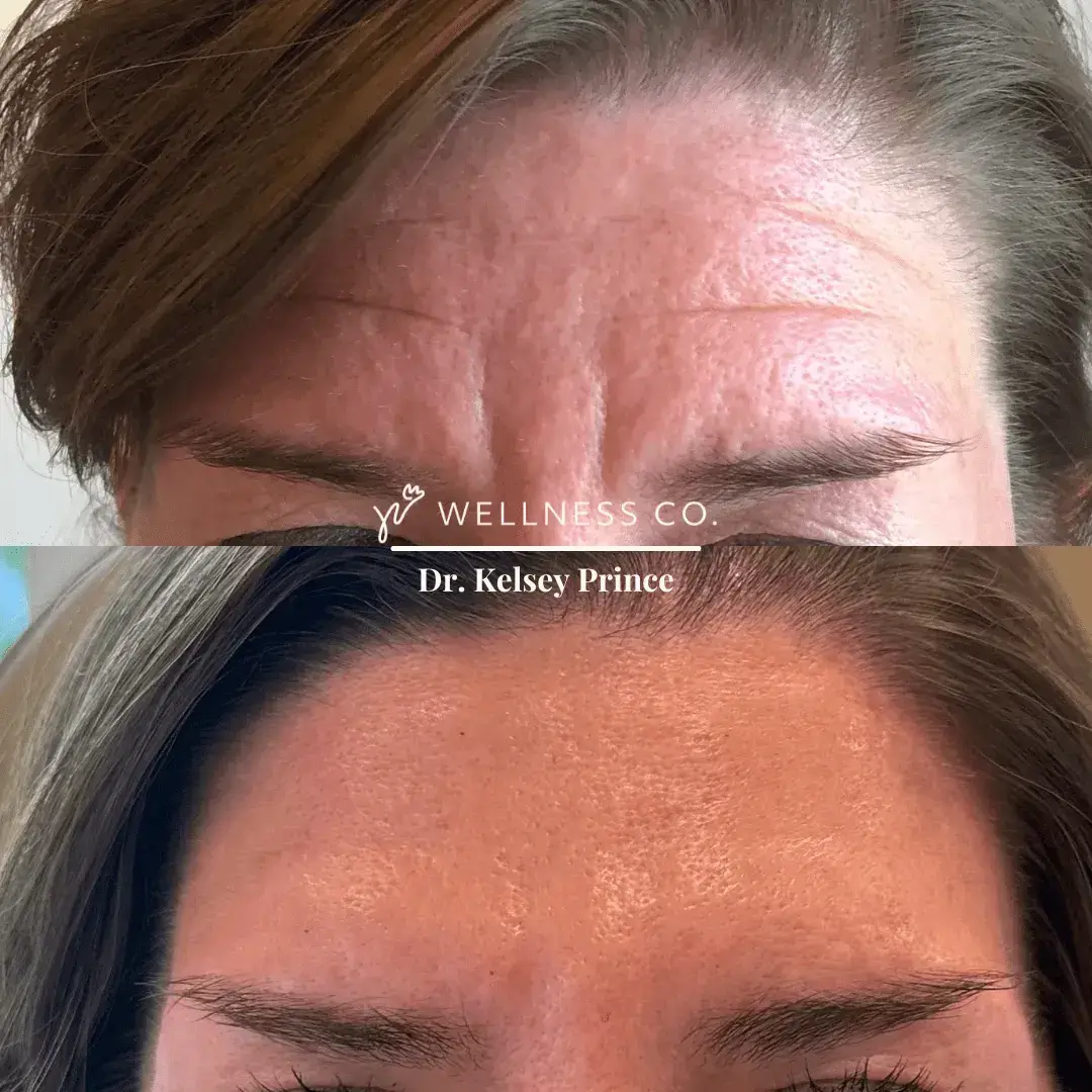 Before and After Photo | Botox for frown lines | Wellness Co. | Zeeland, MI