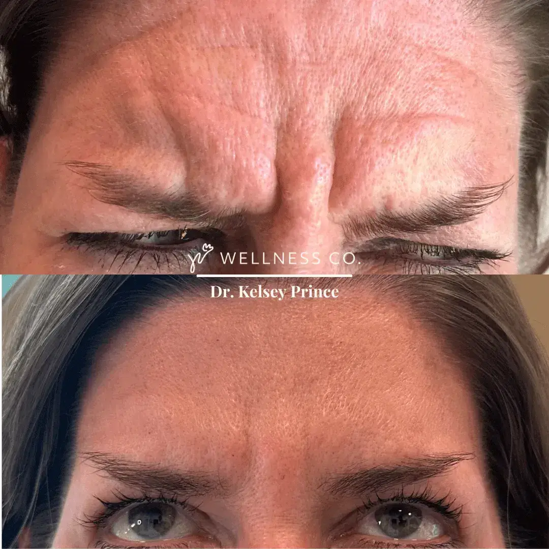 Before and After Photo | Botox for deep frown lines | Wellness Co. | Zeeland, MI