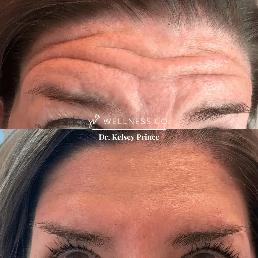 Before and After Photo | Botox for forehead lines | Wellness Co. | Zeeland, MI