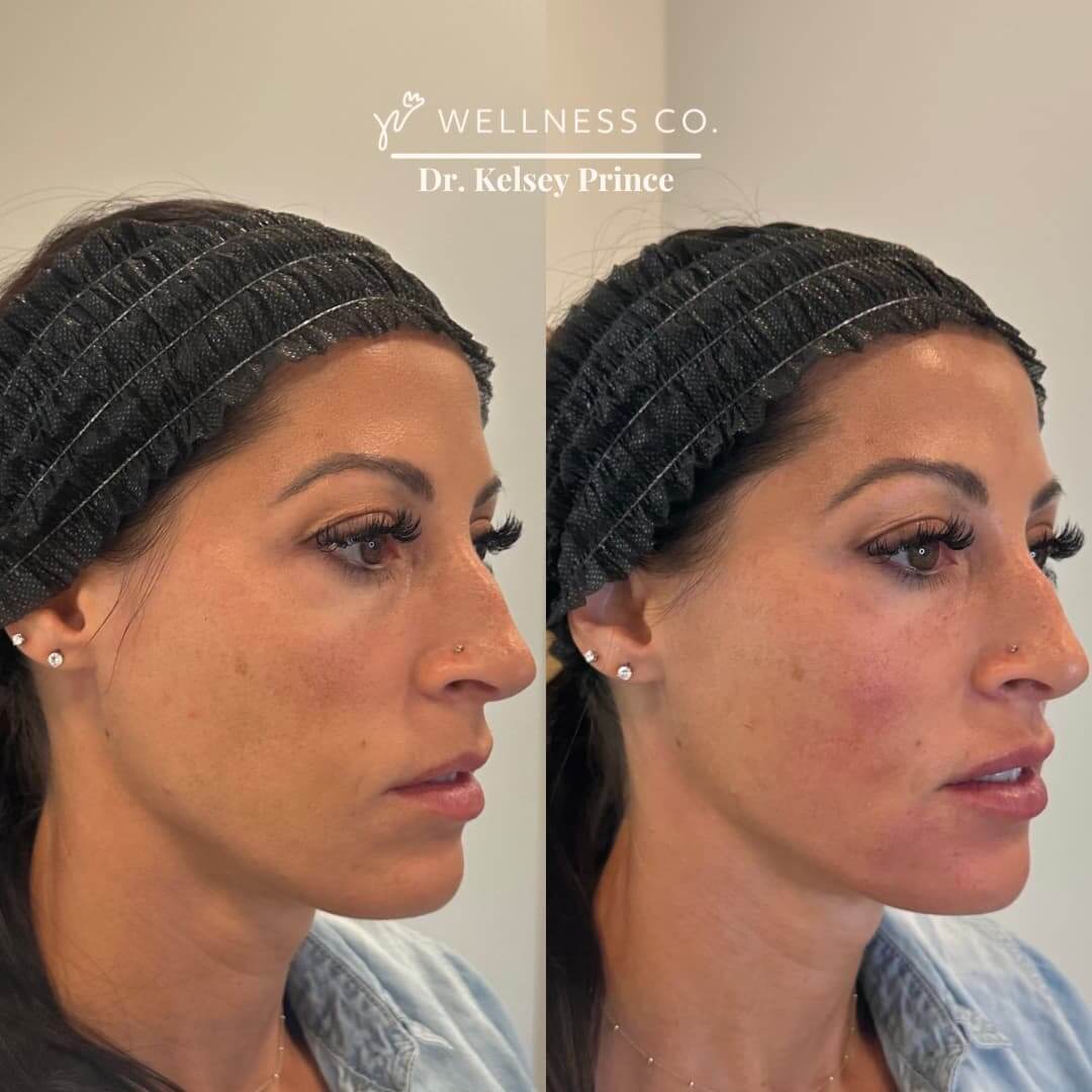 Before and After Photo | dermal filler for full face area | Wellness Co. | Zeeland, MI