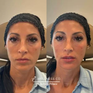Before and After Photo | Botox for full face | Wellness Co. | Zeeland, MI