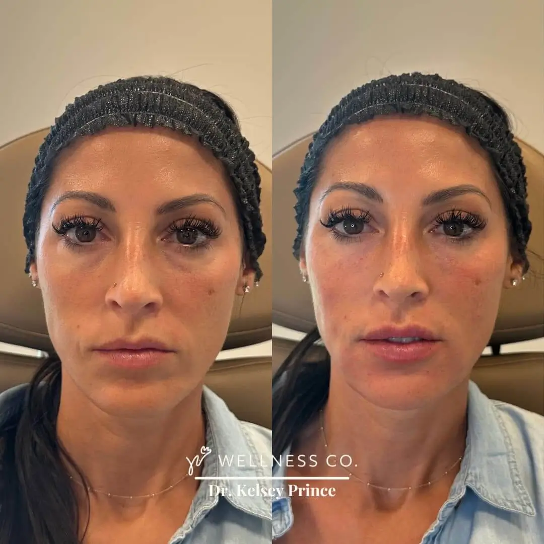 Before and After Photo | Botox for full face | Wellness Co. | Zeeland, MI