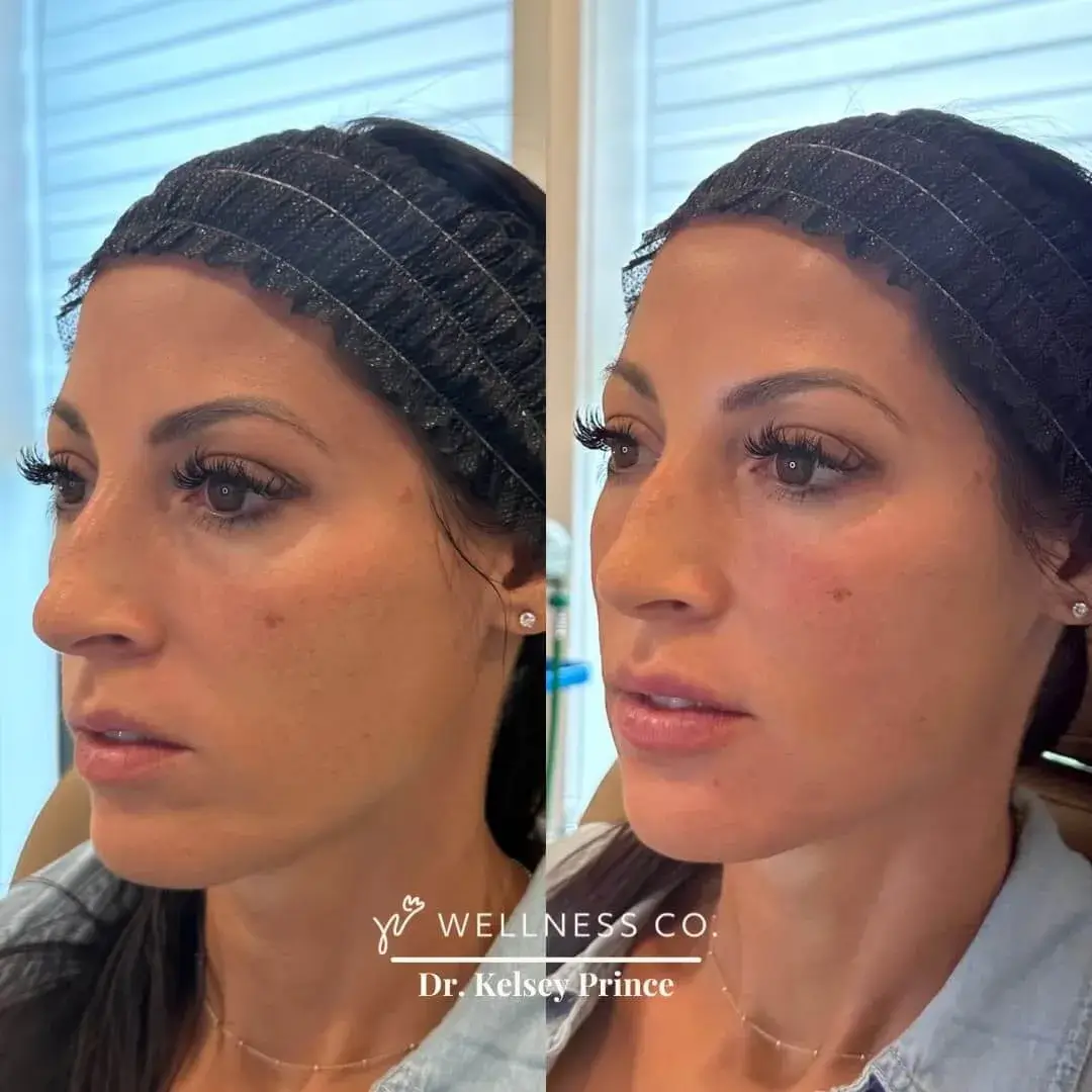 Before and After Photo | full face dermal filler | Wellness Co. | Zeeland, MI