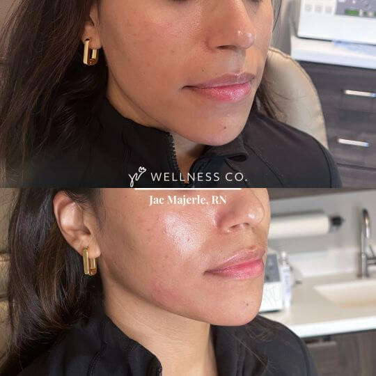 Before and After Photo | filler for chin | Wellness Co. | Zeeland, MI