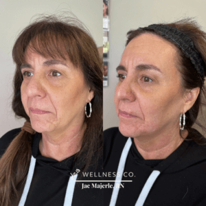 Before and After Photo | Old lady undergone chin shadowing | Wellness Co. | Zeeland, MI
