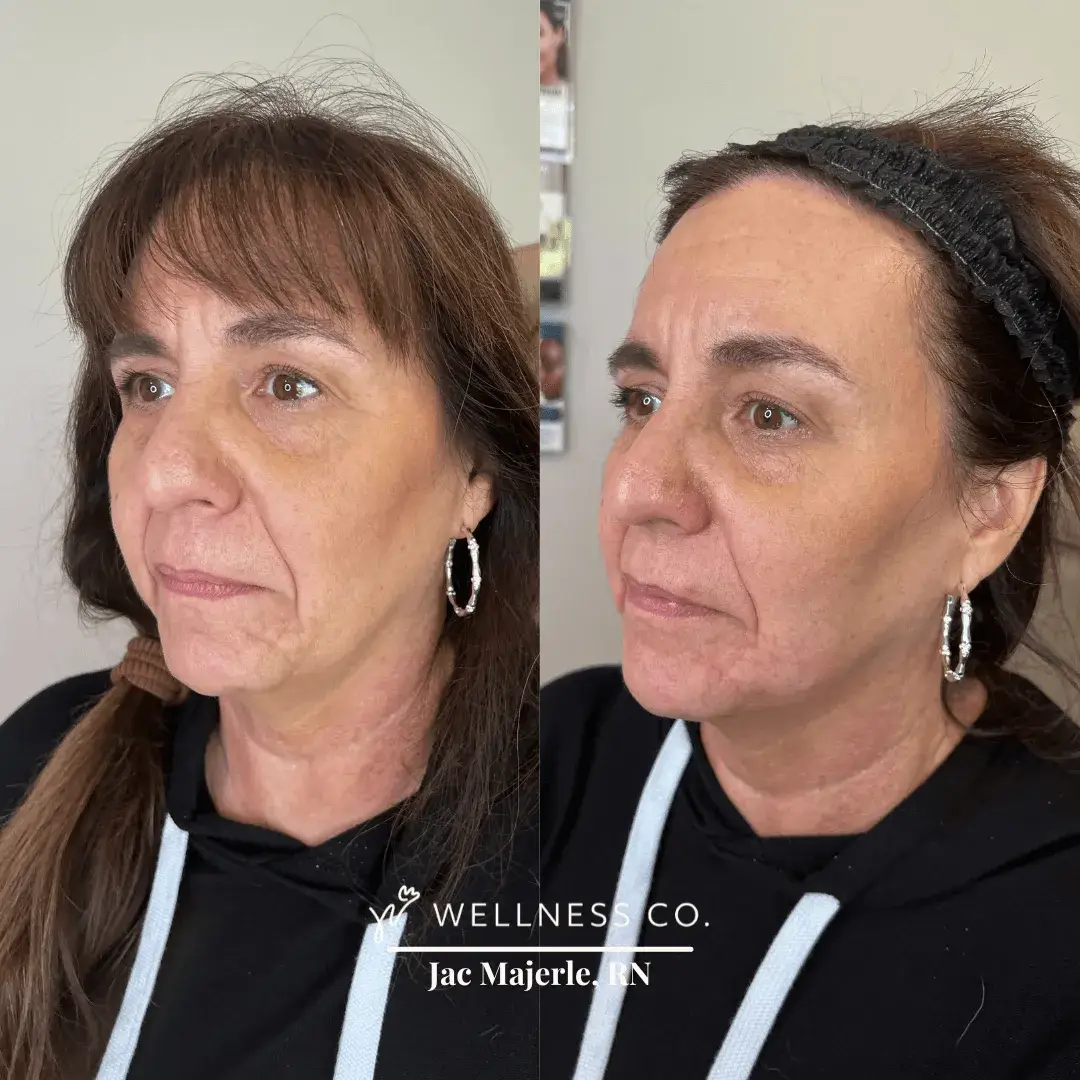 Before and After Photo | Old lady undergone chin shadowing | Wellness Co. | Zeeland, MI