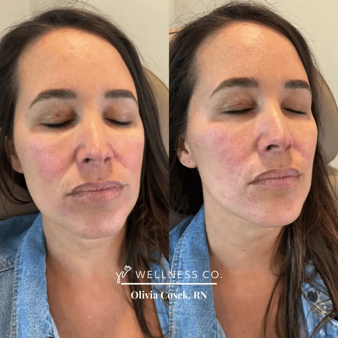 Before and After Photo | mid face filler treatment | Wellness Co. | Zeeland, MI