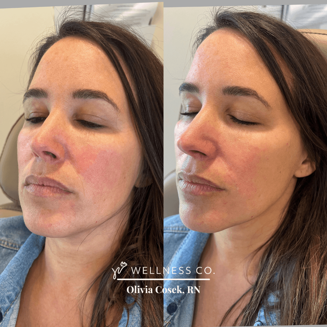 Before and After Photo | dermal filler for mid face | Wellness Co. | Zeeland, MI