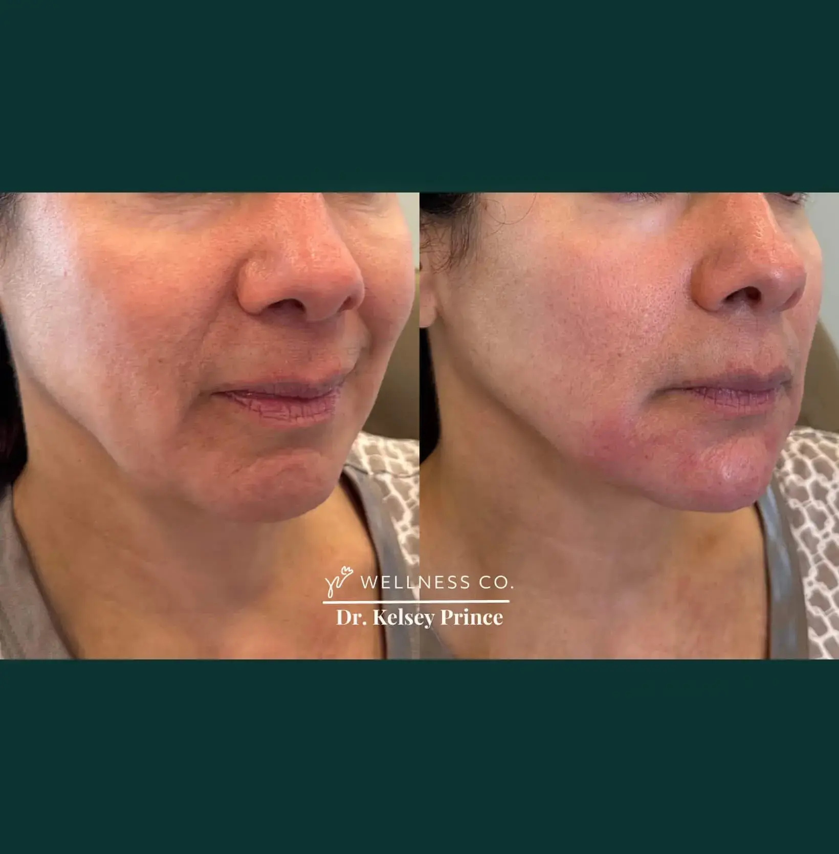 Before and After Photo | filler for lower face | Wellness Co. | Zeeland, MI