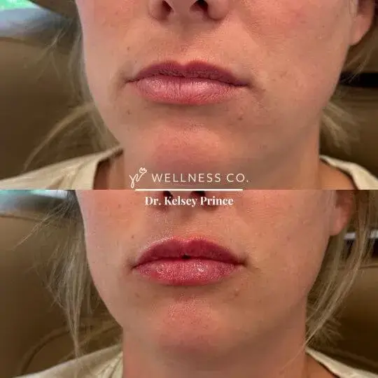 Before and After Photo | lip filler | woman lips | Wellness Co. | Zeeland, MI