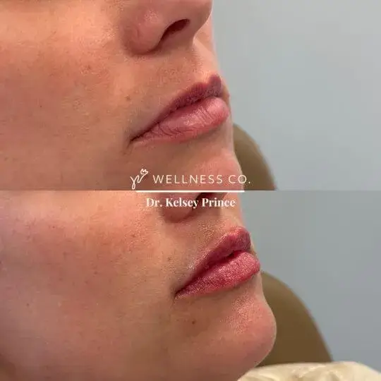 Before and After Photo | lip filler undergone by woman | Wellness Co. | Zeeland, MI