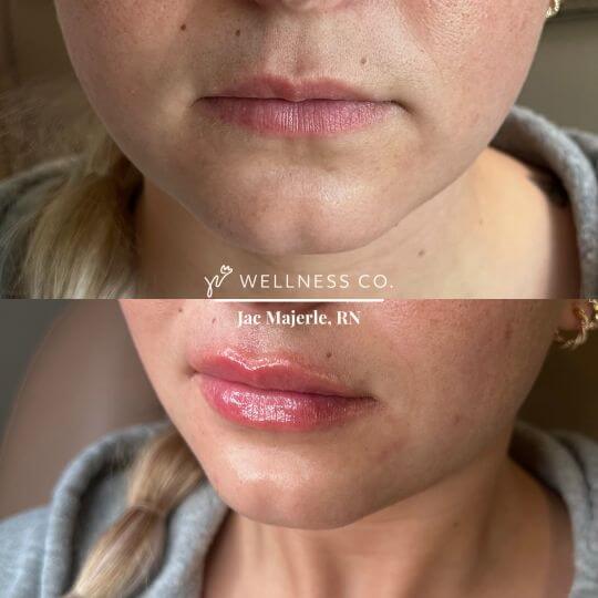 Before and After Photo | Lip filler | Wellness Co. | Zeeland, MI