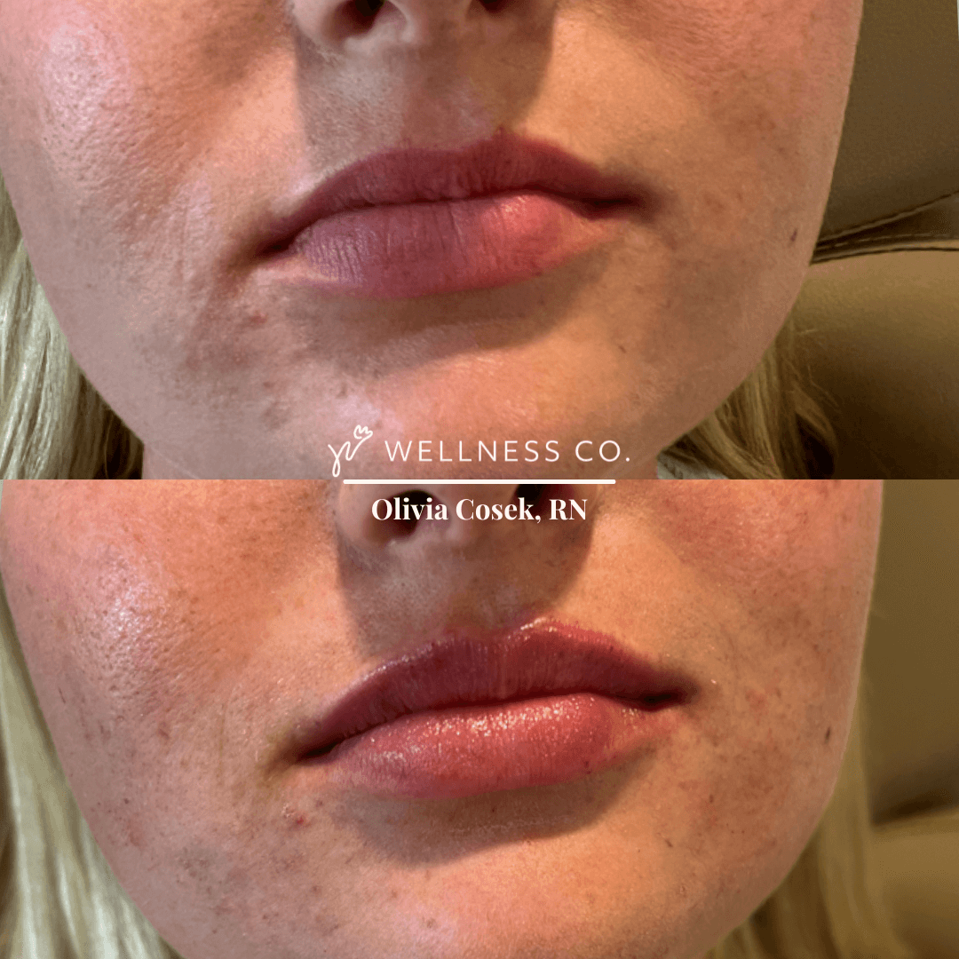 Before and After Photo | lip filler of woman | Wellness Co. | Zeeland, MI