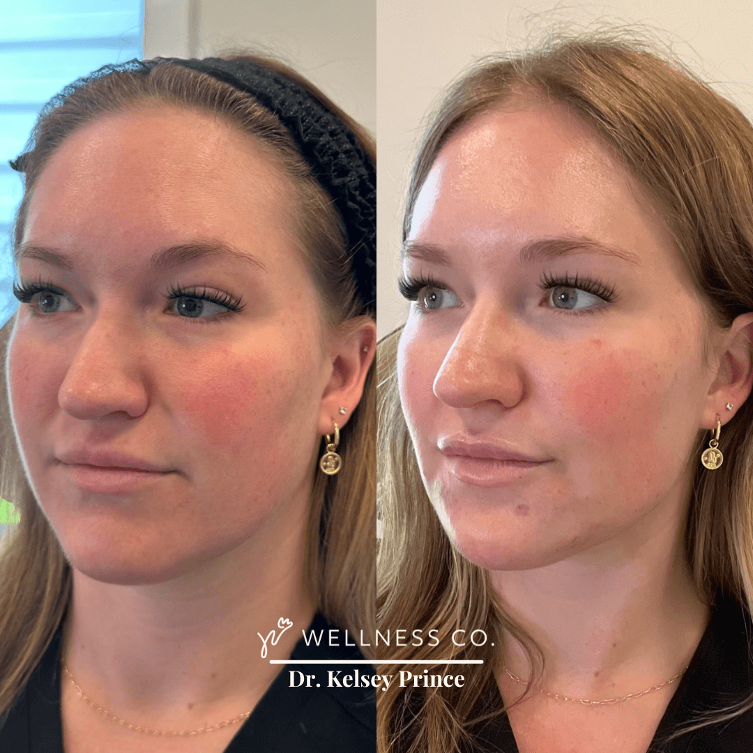 Before and after Photo | Filler treatment | Woman face | Wellness Co. | Zeeland, MI