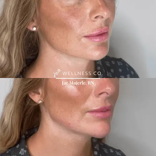 Dermal Filler Lower Face