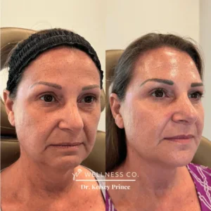 Before and After Photo | full facial balancing | Wellness Co. | Zeeland, MI