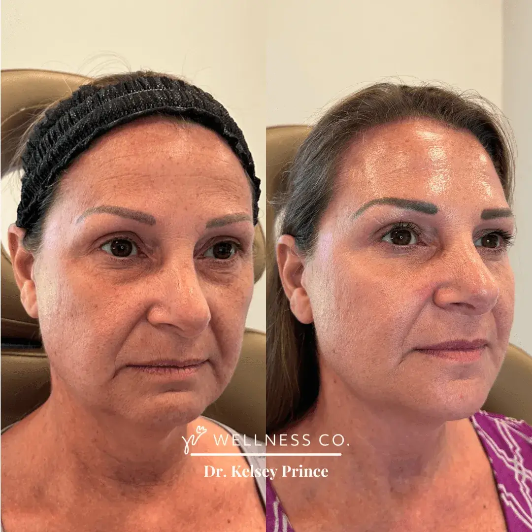 Before and After Photo | full facial balancing | Wellness Co. | Zeeland, MI