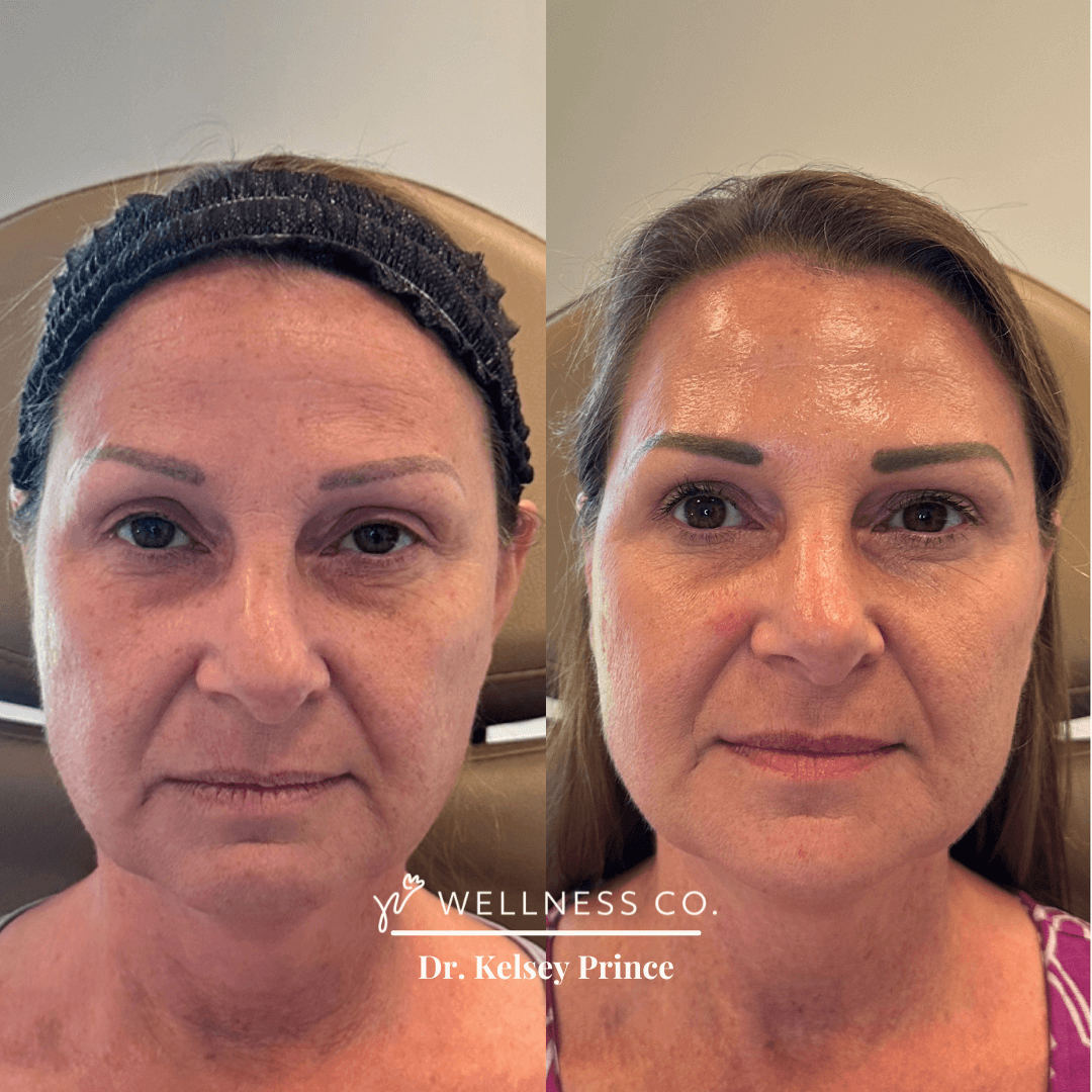 Before and After Photo | full facial balancing | front pose | Wellness Co. | Zeeland, MI