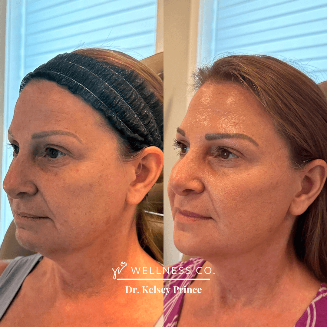 Before and After Photo | full facial balancing | side pose | Wellness Co. | Zeeland, MI