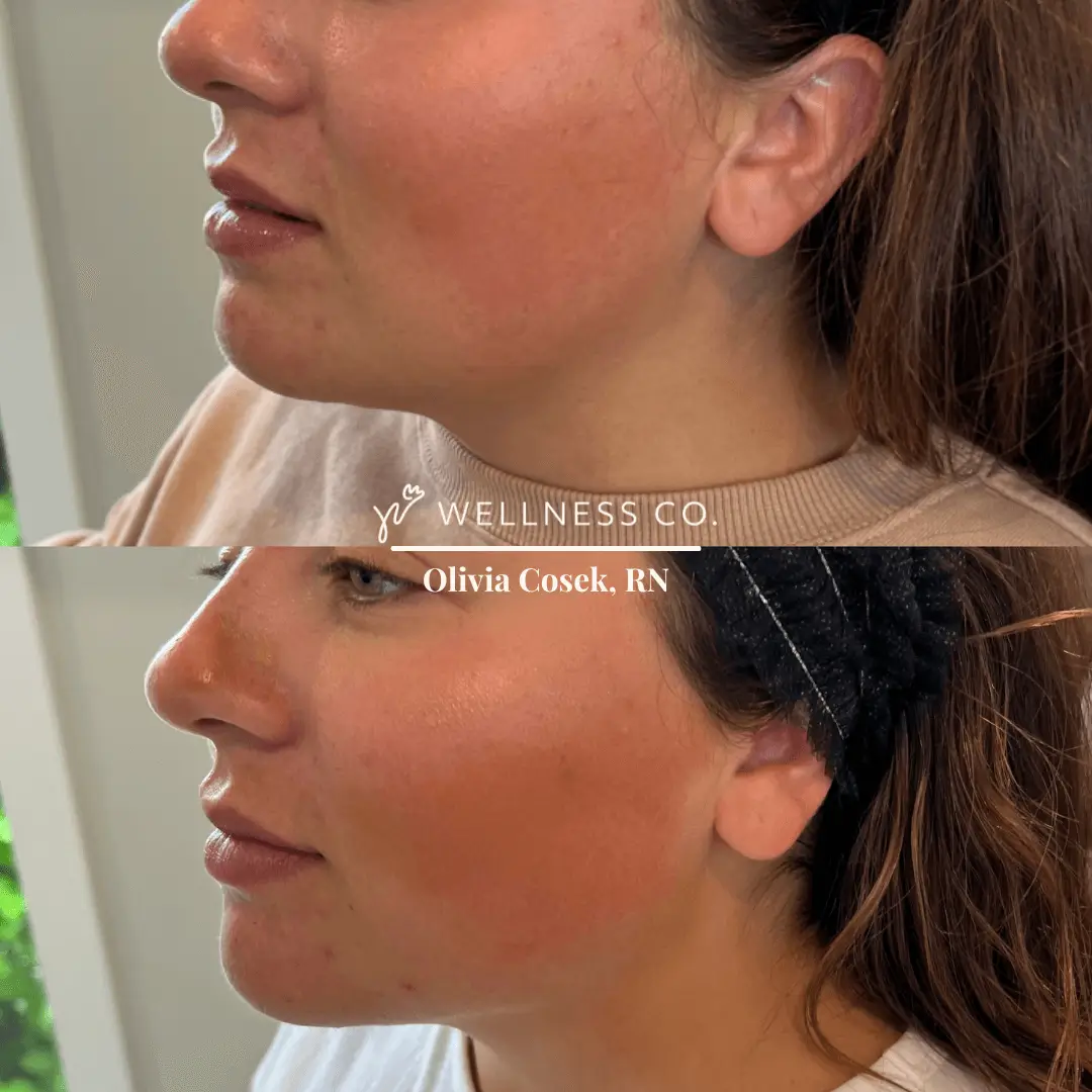 Before and After Photo | Dermal Filler | Wellness Co. | Zeeland, MI