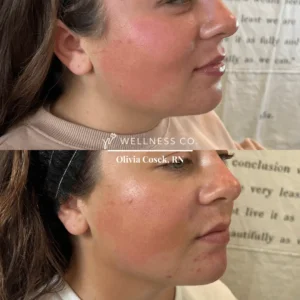 Before and After Photo | filler on face | Wellness Co. | Zeeland, MI