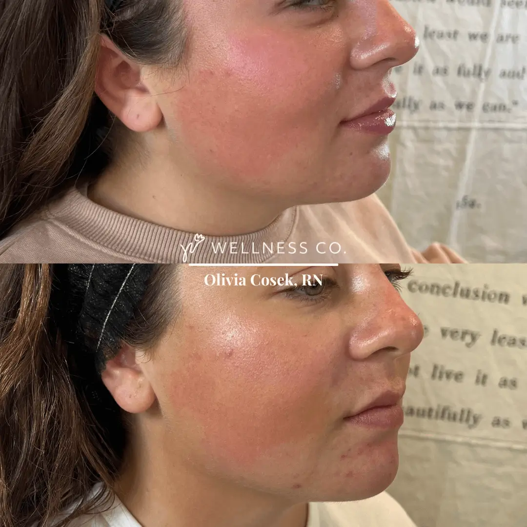 Before and After Photo | filler on face | Wellness Co. | Zeeland, MI