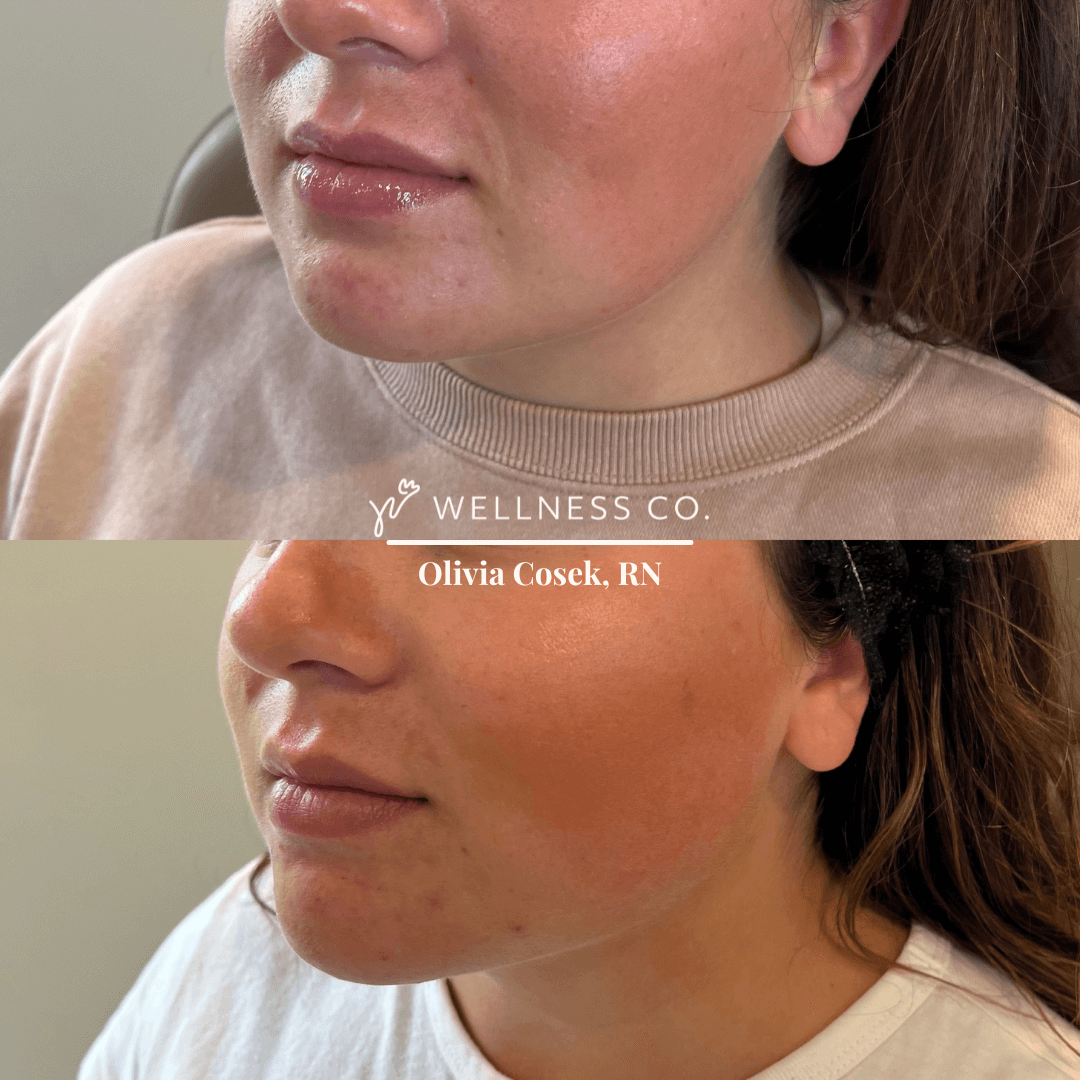 Before and After Photo | dermal filler on lower face | Wellness Co. | Zeeland, MI