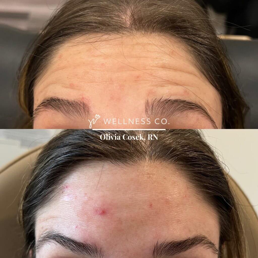 Before and After Photo | Botox | Wellness Co. | Zeeland, MI
