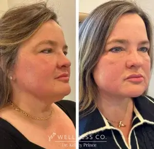 A graphic or photo for Facetite and Bodytite treatments.