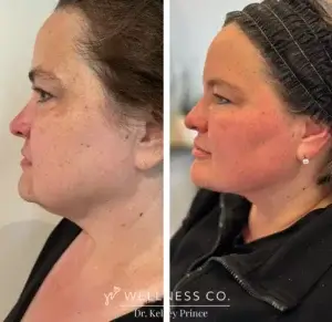 A second graphic or photo for Facetite and Bodytite treatments.
