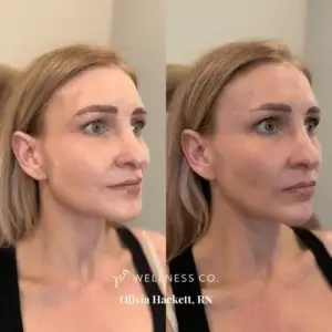 dermal filler