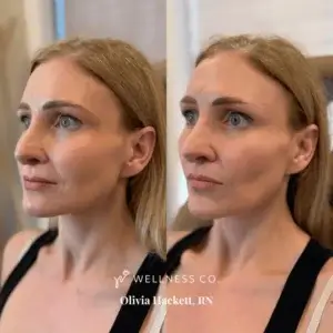 dermal filler