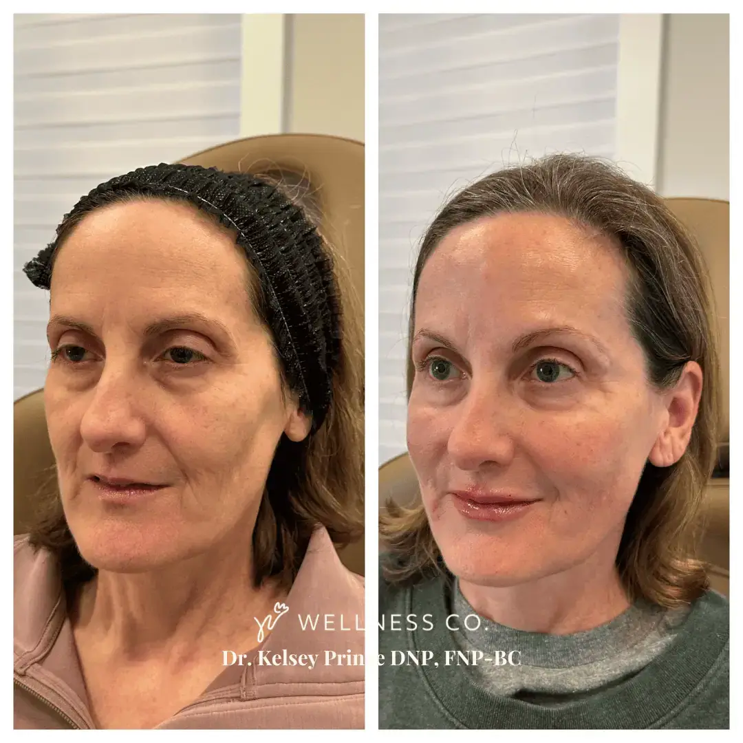 dermal filler