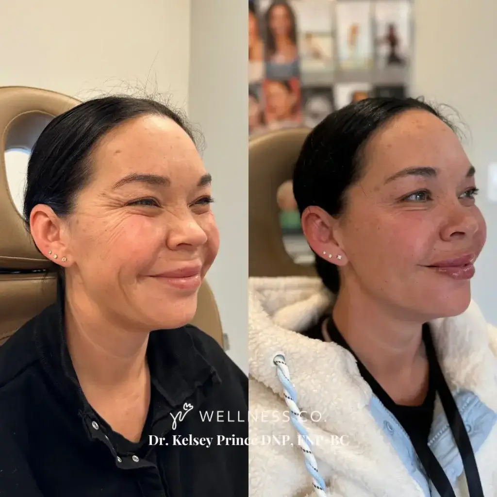 A logo or image related to the Skinvive treatment.