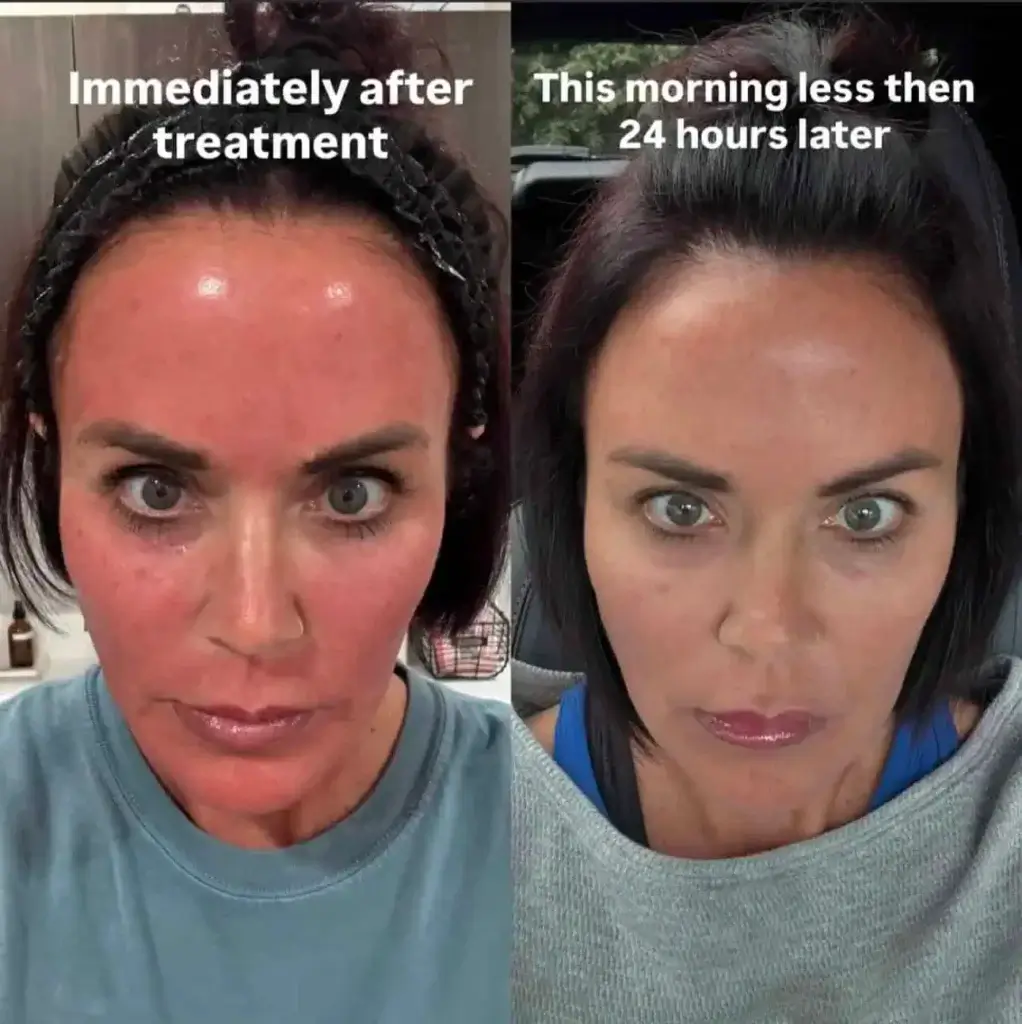 PDGF Treatment: After Treatment