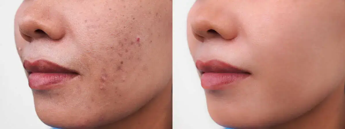 Before and after acne treatment showing skin improvement from breakouts often caused by hormonal imbalance