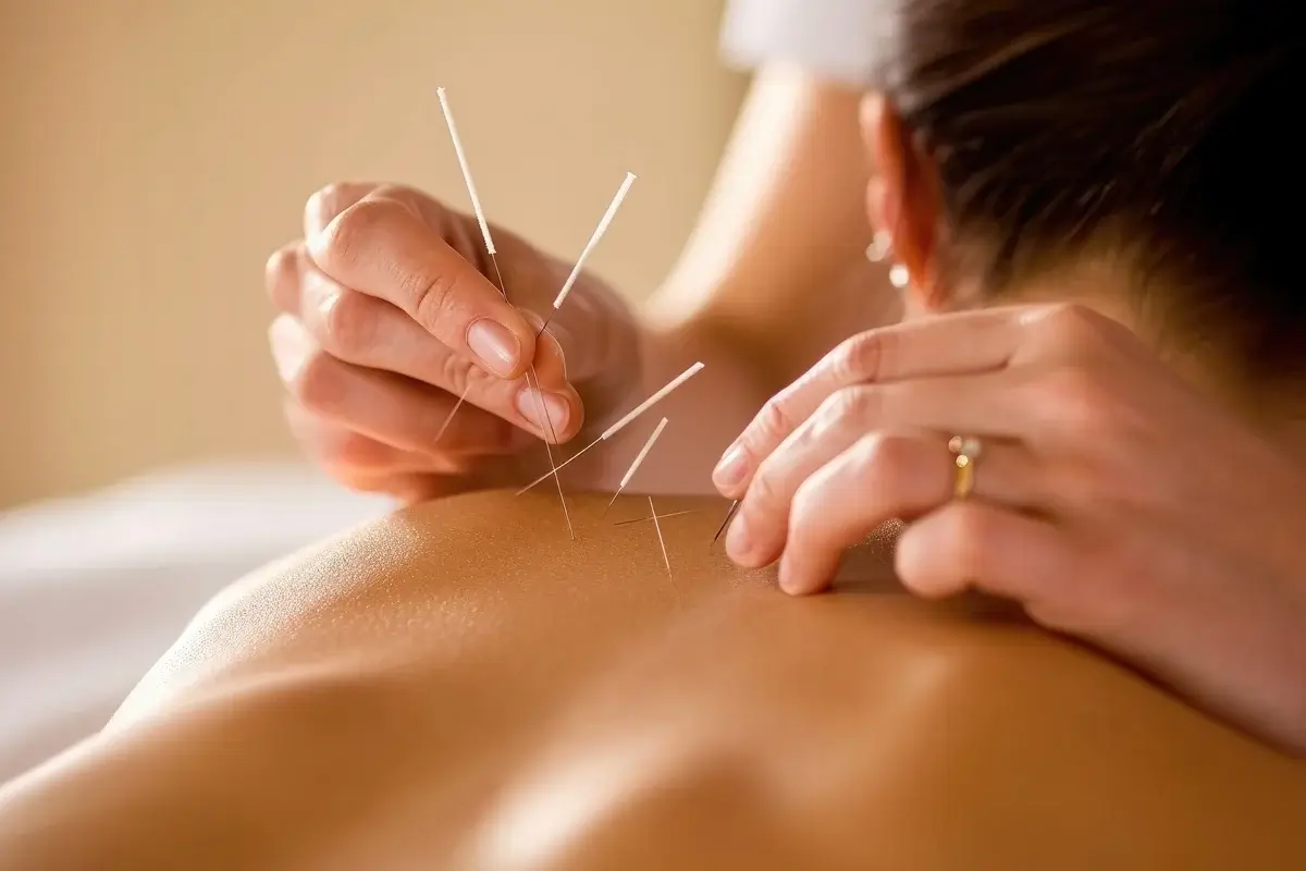 Woman receiving acupuncture for stress and mental fog treatment at Wellness Co.