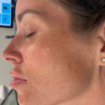 Before and After results of IPL treatment | Wellness Co in Zeeland, MI