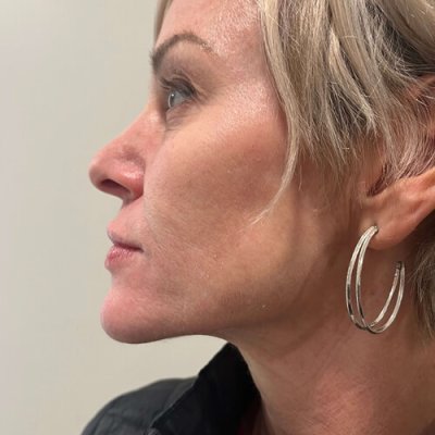 Before and After results of IPL treatment | Wellness Co in Zeeland, MI