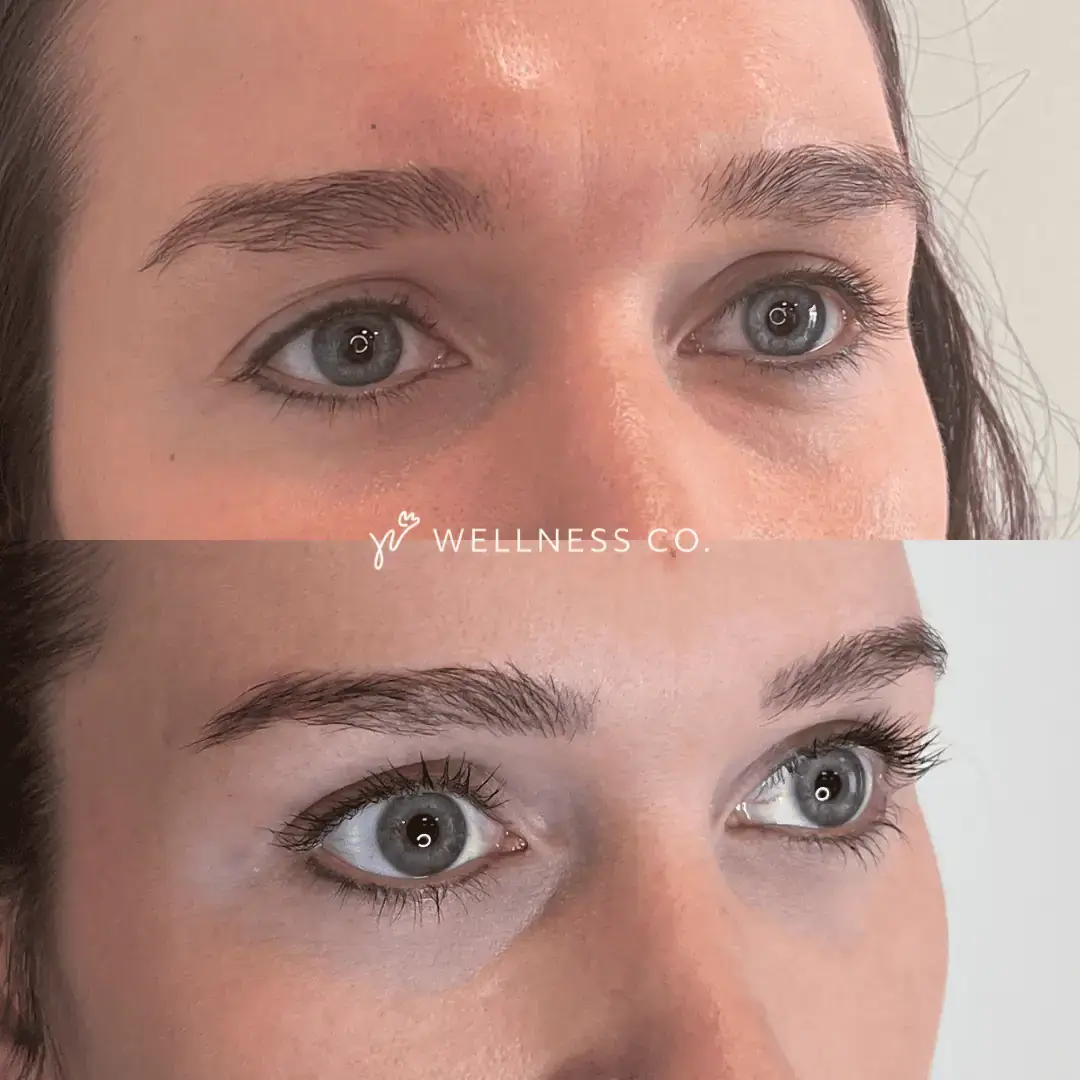 PRF Injections