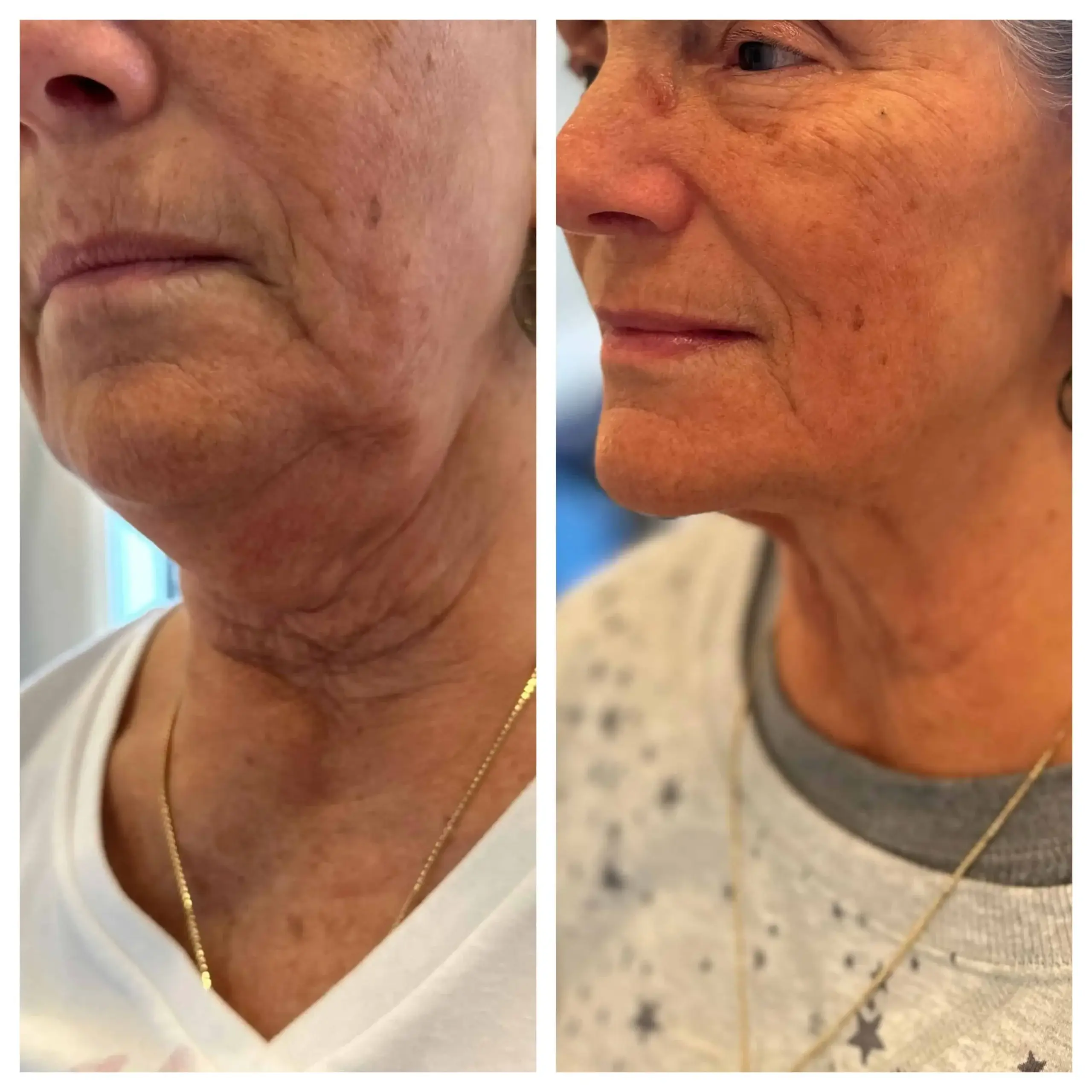 Facetitle & Bodytite